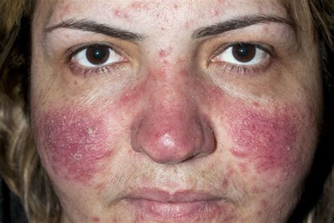 Skin And Facial Treatments: Rosacea