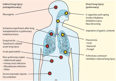 Acute Respiratory Distress Syndrome: Causes,, 53% OFF