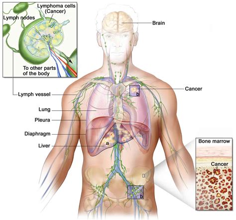 Waldenstrom macroglobulinemia causes, symptoms, diagnosis, prognosis ...