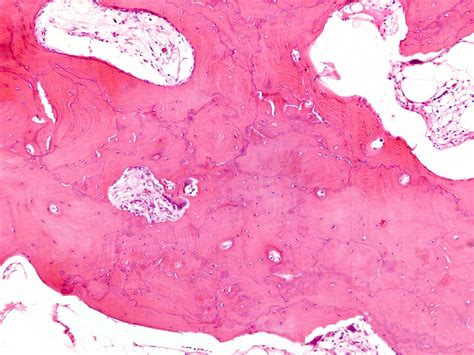 Paget Disease Of Bone Histology | Hot Sex Picture