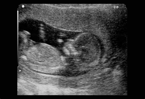 12 Weeks Pregnant Ultrasound: Process, Abnormalities & Accuracy