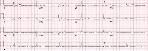 Complete (3rd Degree) Heart Block on ECG ECG of a ... | GrepMed