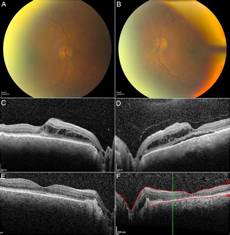 Laser treatment of macular retinoschisis due to acquired optic nerve pit from glaucoma | BMJ ...