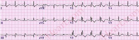 Right Bundle Branch Block (RBBB) ECG Review - Criteria and Examples | LearntheHeart.com