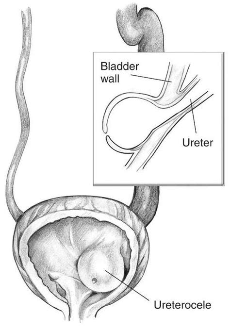 Ureterocele