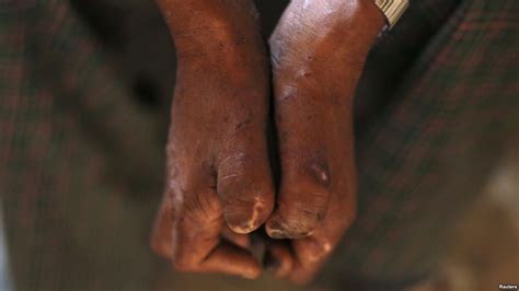 Leprosy hits 7 districts in Malawi as typhoid fever terrorises Neno ...