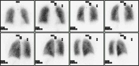 Lung ventilation/perfusion scan | medicine | Britannica