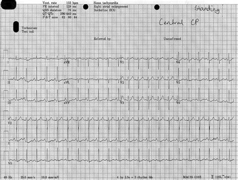 Inappropriate sinus tachycardia in pregnancy: a benign phenomena? | BMJ Case Reports