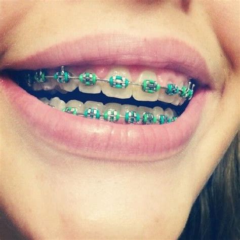 Bracesss | Green braces, Braces colors, Dental braces