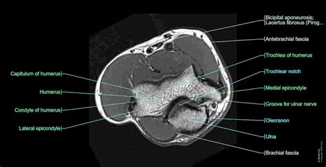 Elbow MR: normal anatomy | e-Anatomy