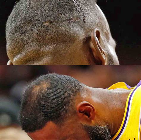 Lebron James Hair - Hair Transplant Analysis by Matt Dominance