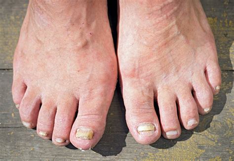 Onychomycosis With Fungal Nail Infection Stock Photo - Download Image Now - iStock