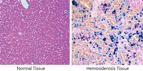 What is Hemosiderin staining - How to get rid of Hemosiderin Staining