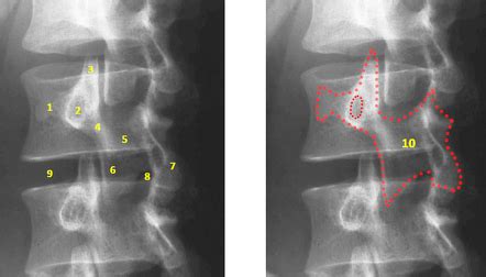 Lumbar spine | Radiology Reference Article | Radiopaedia.org
