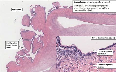 Ovary – Serous Cystadenoma – NUS Pathweb :: NUS Pathweb