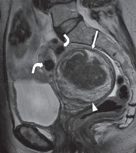 A 71-year-old woman shown to have uterine fibroids whil | Open-i