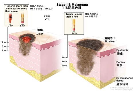 がん情報サイト | がん情報各論：[医療専門家向け]黒色腫の治療(PDQ®)