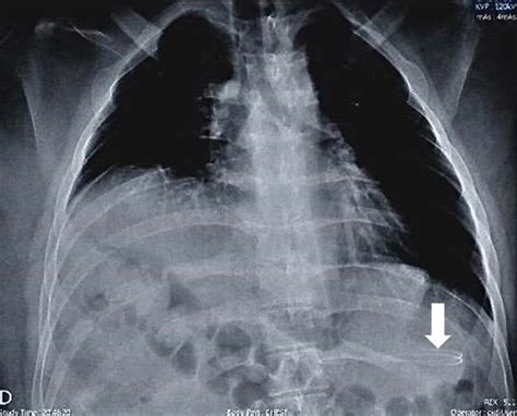 Chest X-ray showing a ventriculoperitoneal (VP) shunt catheter in the... | Download Scientific ...