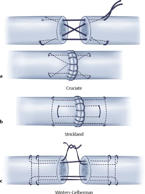 Flexor Tendon Repair | Plastic Surgery Key