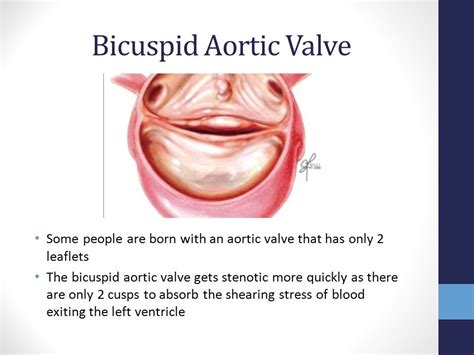 Pin by Tina Gady Hughes on Andy heart health | Bicuspid aortic valve, Chd awareness, Aortic ...