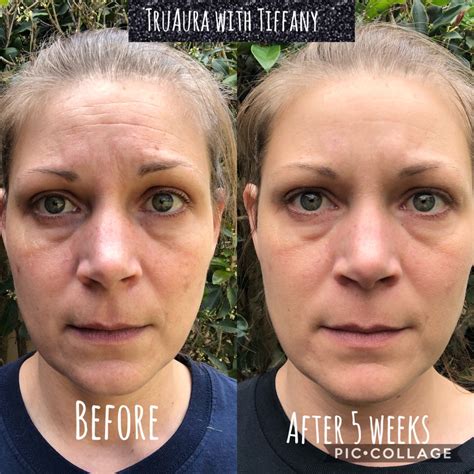 My personal before and after! ️ ️ ️ #skincare #truaurawithtiffany # ...