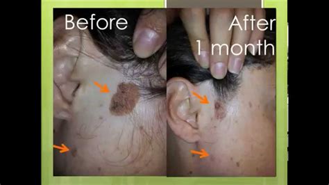 Natural treatment for seborrheic keratosis before and after photos ...