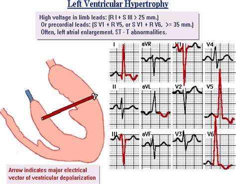 Left Ventricular Hypertrophy (LVH) pada EKG? | SholehShare