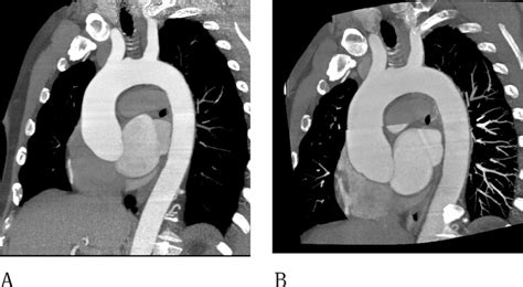 CT and MR imaging of the thoracic aorta