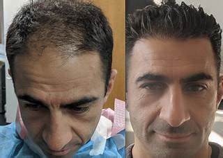 Samson Hair Restoration