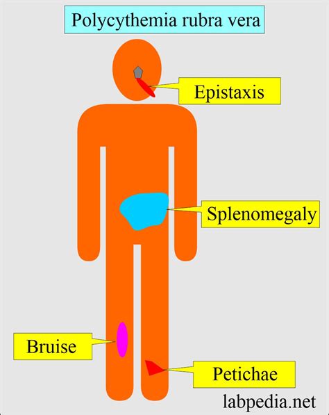 Polycythemia (Erythrocytosis), Polycythemia Rubra Vera, and Secondary Polycythemia - Labpedia.net