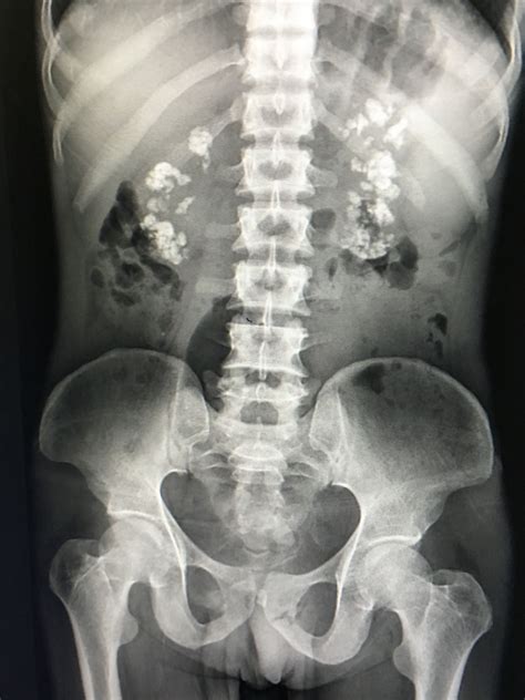 Bilateral Medullary nephrocalcinosis Renal, Life And Death, X Ray, Medical School, Scrubs ...