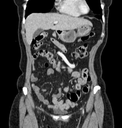 Intestinal malrotation | Radiology Case | Radiopaedia.org