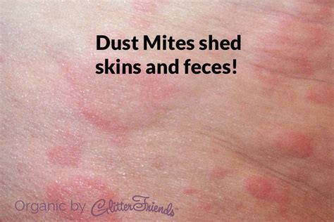 Skin Mites On Humans