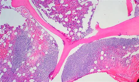 Follicular Lymphoma in Bone Marrow | This bone core is from … | Flickr