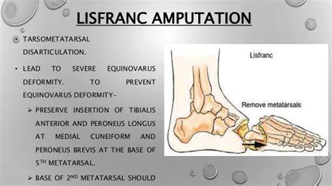 Amputation Of Foot - Physiotherapy Treatment, Exercise,