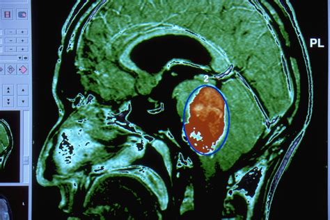 Glioma and Brain Cancer Treatments