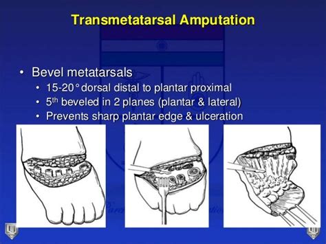 Lecture 31 parekh amputations