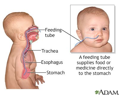 Feeding tube - infants - UF Health