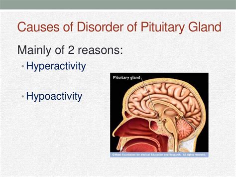 Neurologic Disorders Of The Pituitary And Hypothalamus Diseases Of | My ...