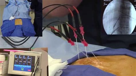 Radiofrequency Ablation Explanation Video Demonstration - LIVE! - YouTube