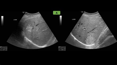 Hepatic Hemangiomas - Manal's Classroom