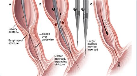 Savary dilation of a benign esophageal stricture. | Download Scientific Diagram