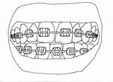 Colorear Para Brackets Coloring Llevar Braces Dibujo Kleurplaat Beugel  sketch template