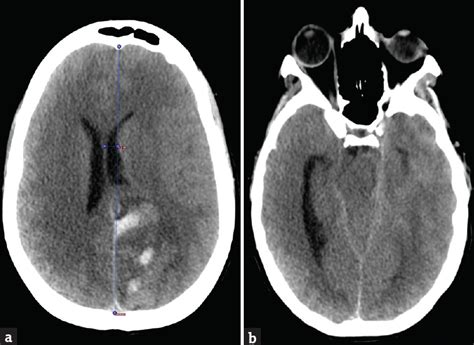 Decompression Hemicraniectomy for Refractory Intracranial Hypertension ...