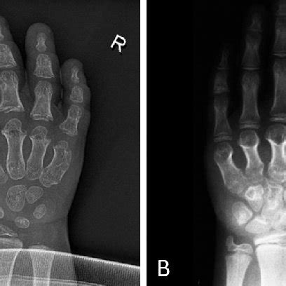 (PDF) Phenotypic variability in a family with Acrodysostosis Type 2 caused by a novel PDE4D ...