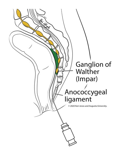 Ganglion Impar Nerve Block Illustration by Keri Leigh Biomedical Creations LLC | Medical ...