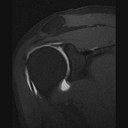 Superior labral anterior posterior tear | Radiology Reference Article | Radiopaedia.org