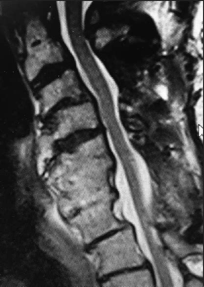 Nursing review of cervical laminectomy and fusion - Surgical Neurology International