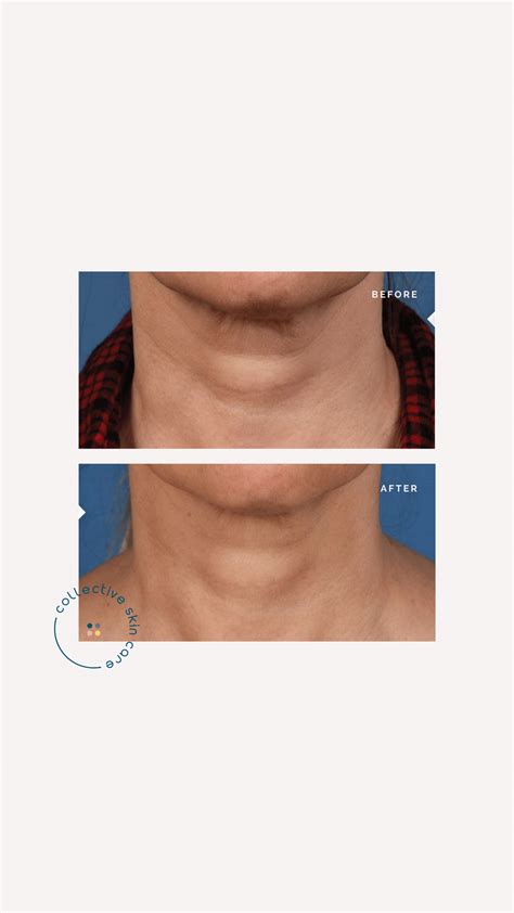 How to solve tech neck; Microneedling for neck wrinkles - Collective ...