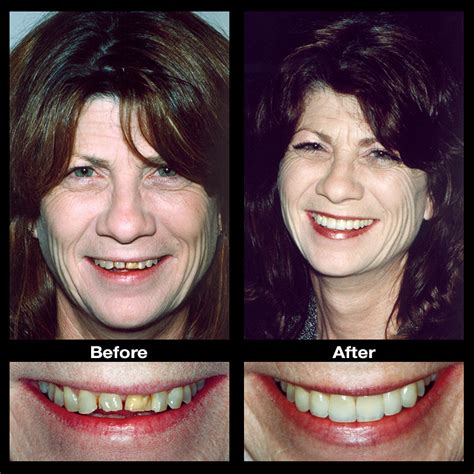 Worn Teeth Repair | Enamel Restoration | Signature Smiles